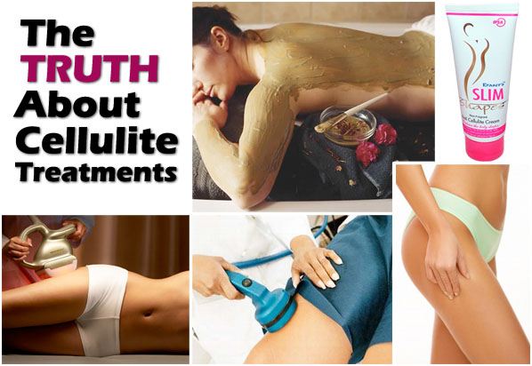 The Truth About Cellulite Treatments post image